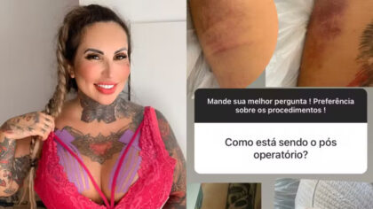 Sabrina Boing Boing enfrenta dificuldades após colocar 6 litros de silicone em cirurgia plástica