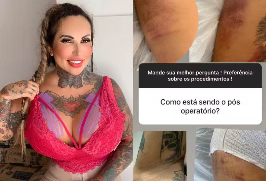 Sabrina Boing Boing enfrenta dificuldades após colocar 6 litros de silicone em cirurgia plástica